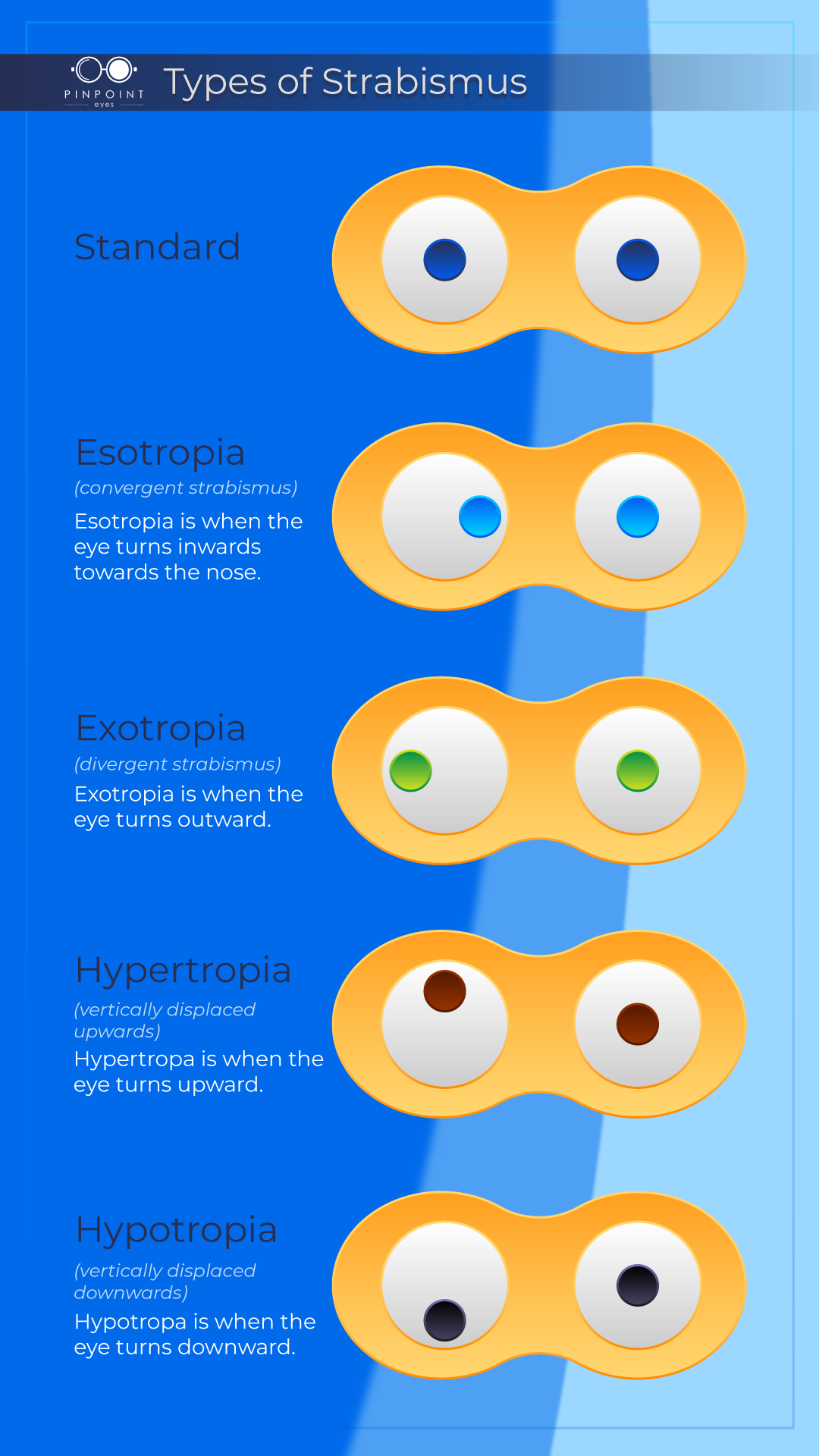 Diagram of the 4 Types of Strabismus