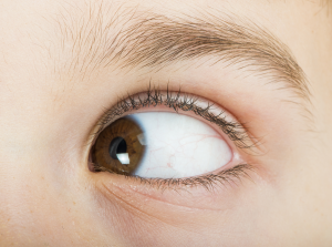 Read more about the article Strabismus