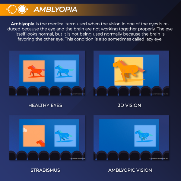 myopia hyperopia amblyopia látásélesség 2 60-ig